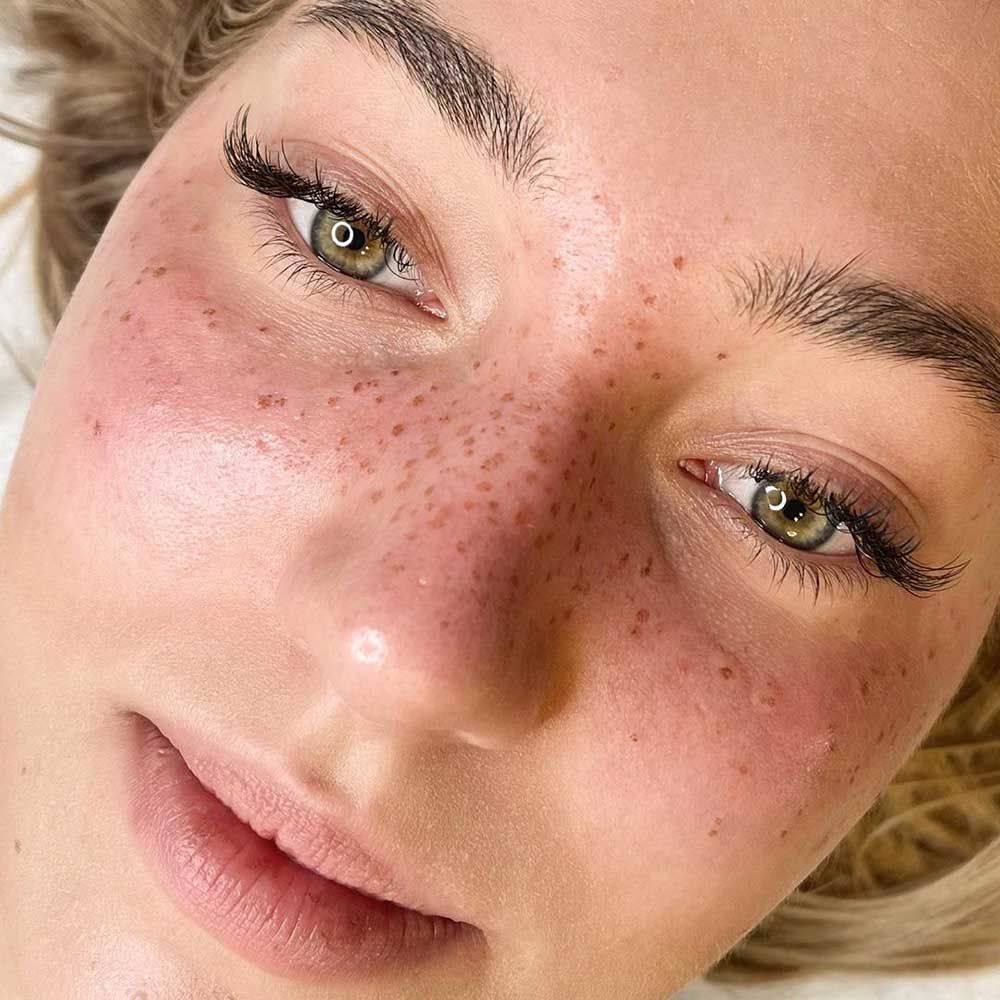 Freckles Sommersprossen Ergebnis München